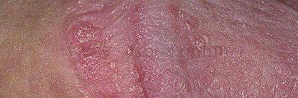 Dry skin at ulser sa ulo ng titi pagkatapos gamitin ang baking soda