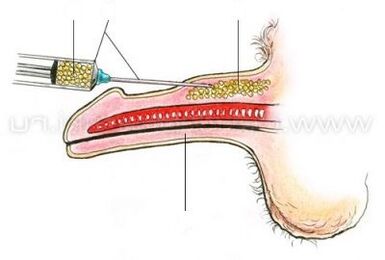 Pagpapalaki ng Penis ng Injection
