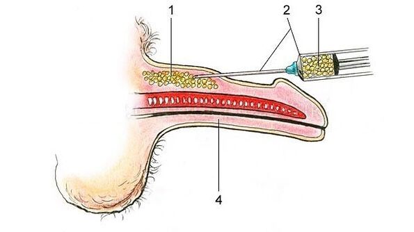 hyaluronic acid injection para lumapot ang ari