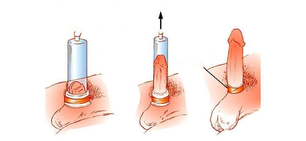 paano gumagana ang penis vacuum pump