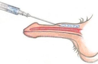 Isang mapanganib na paraan ng pagpapalaki ng ari gamit ang Vaseline injection